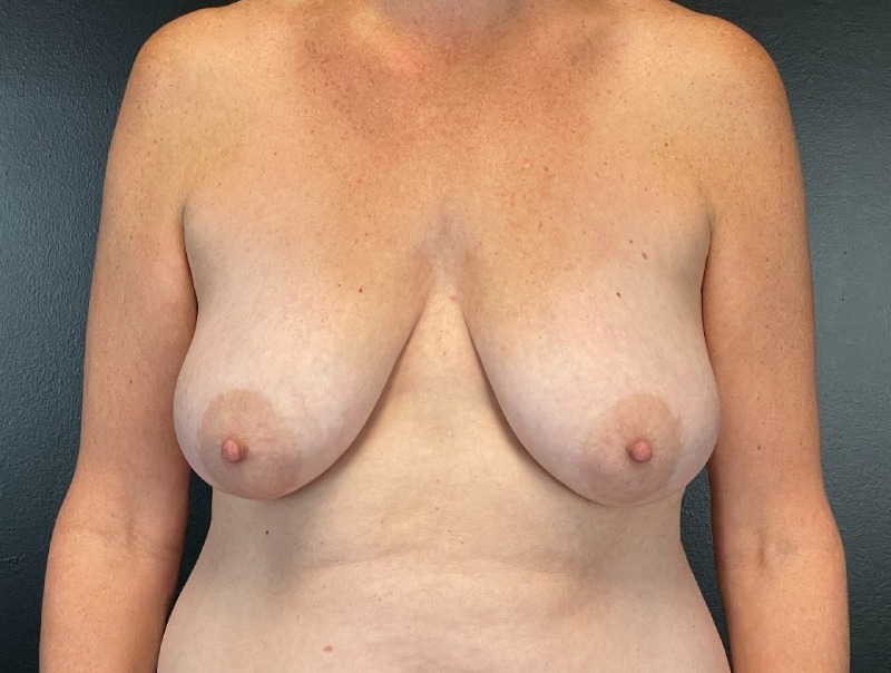 Breast Augmentation Before & After Image
