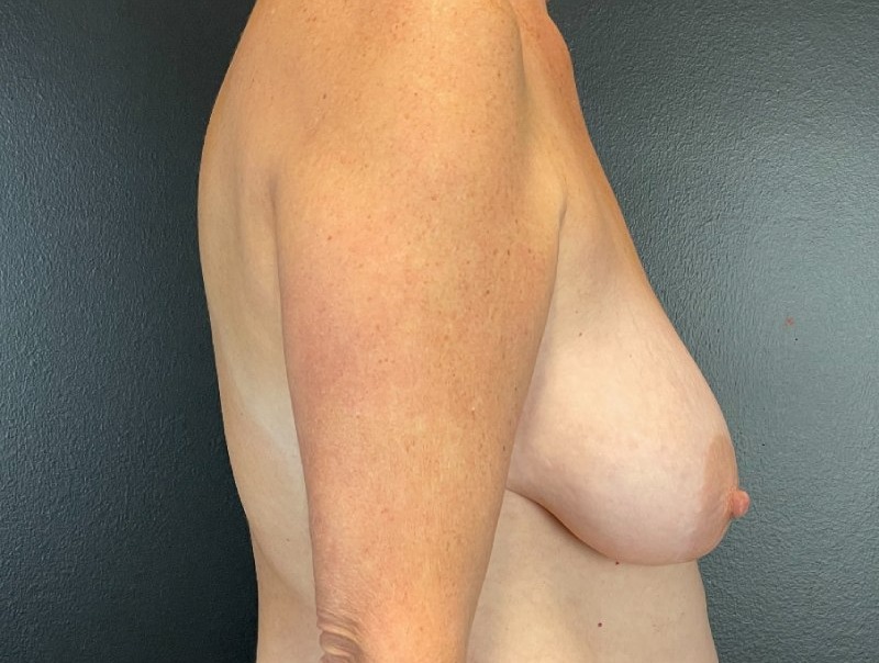 Breast Augmentation Before & After Image