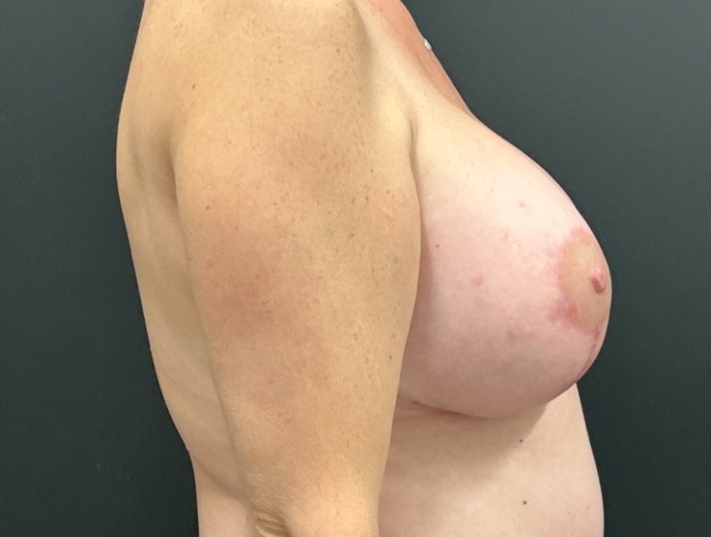 Breast Augmentation Before & After Image