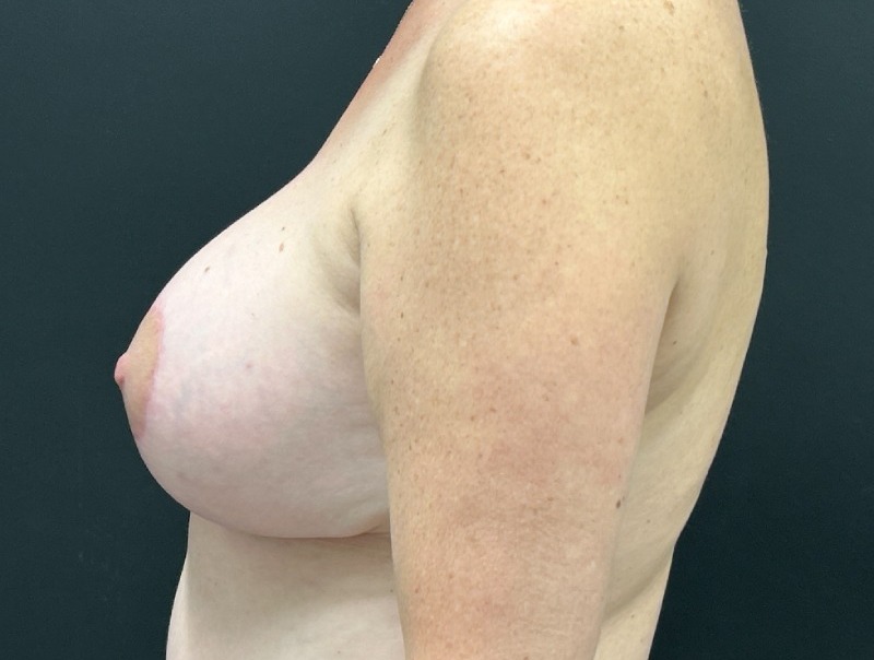Breast Augmentation Before & After Image