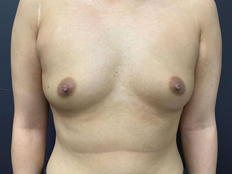 Breast Augmentation Before & After Image
