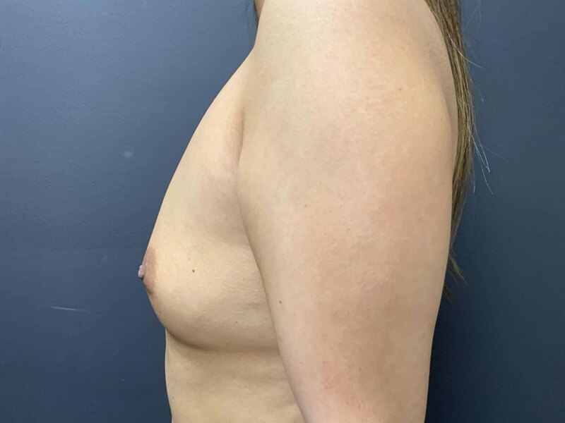 Breast Augmentation Before & After Image