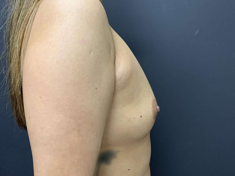 Breast Augmentation Before & After Image