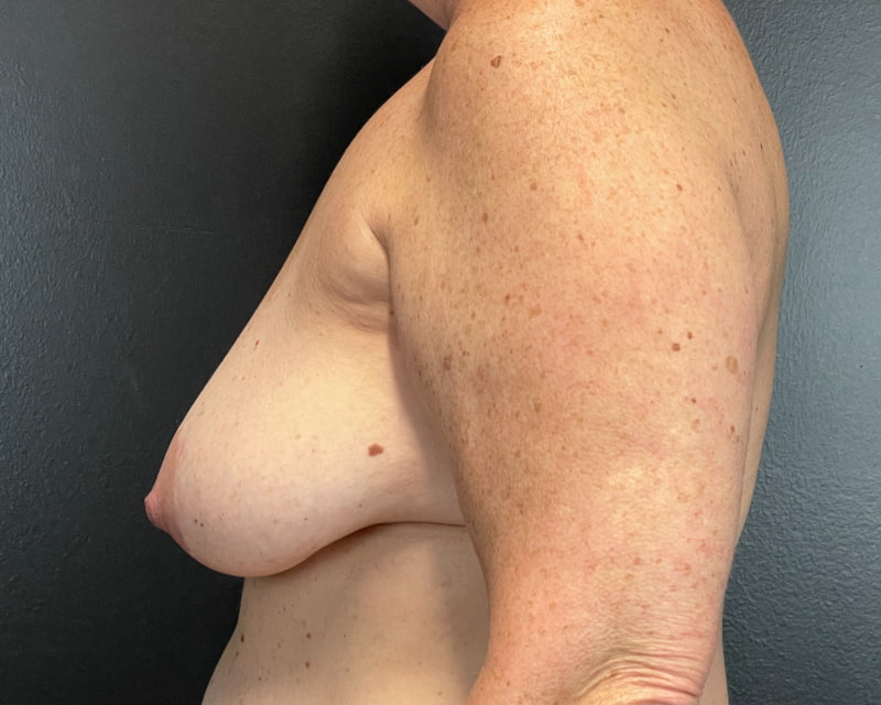 Breast Implant Exchange with Lift Before & After Image