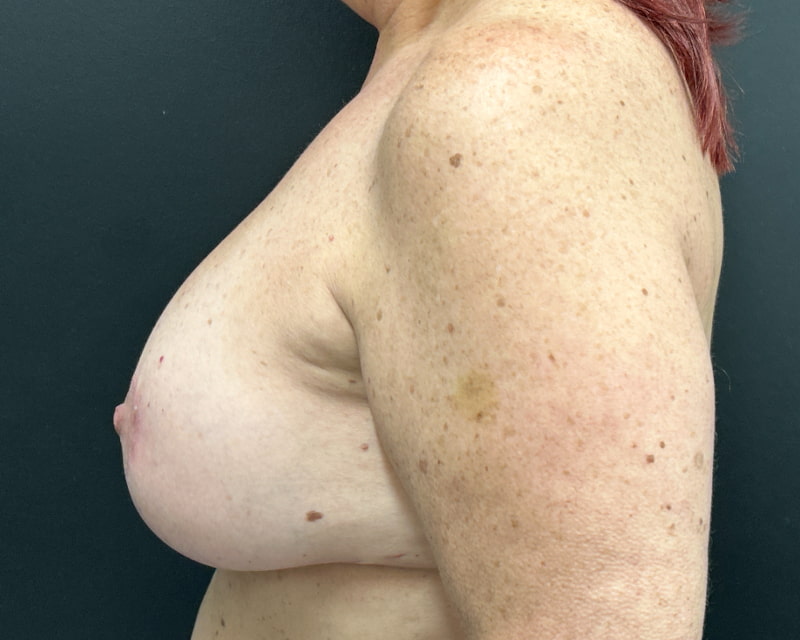 Breast Implant Exchange with Lift Before & After Image