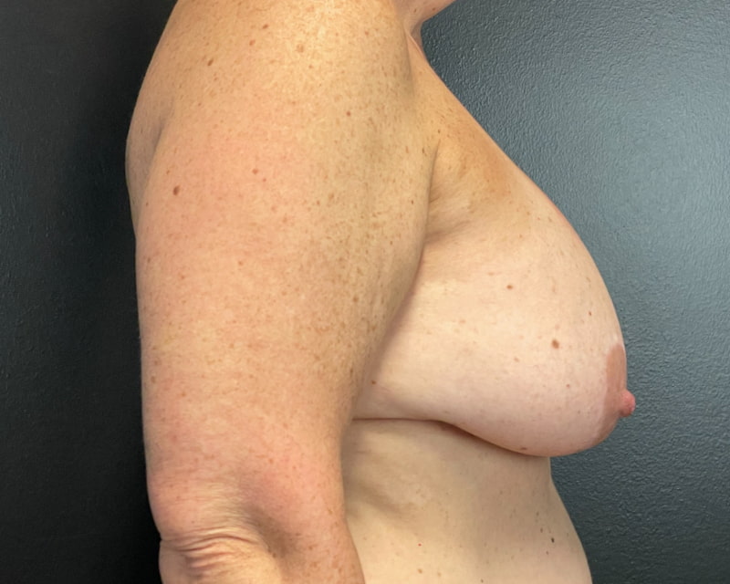 Breast Implant Exchange with Lift Before & After Image