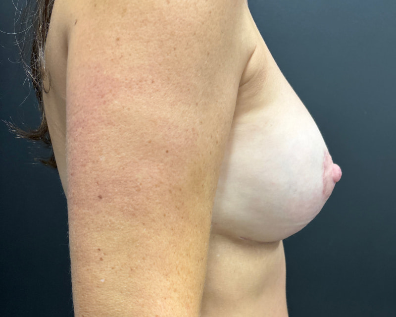 Breast Implant Exchange with Lift Before & After Image