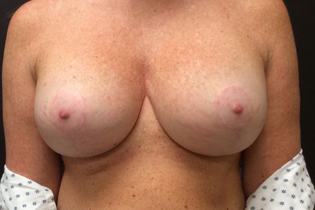 Breast Implant Swap Before & After Image