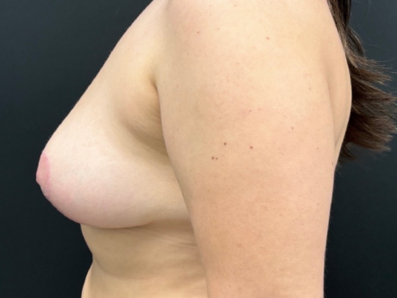 Breast Lift with Fat Grafting Before & After Image