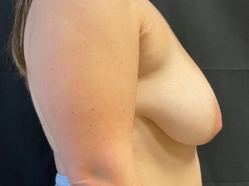 Breast Lift with Fat Grafting Before & After Image