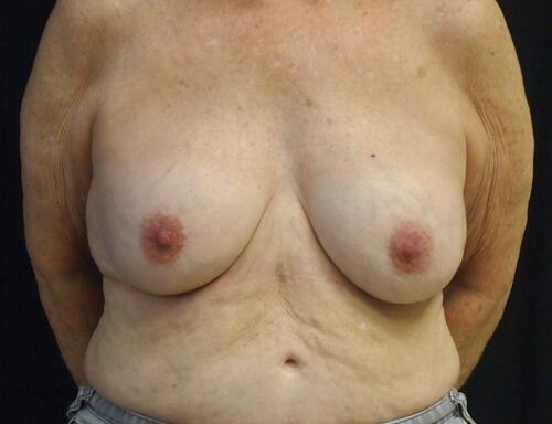 Breast Lift Before & After Image