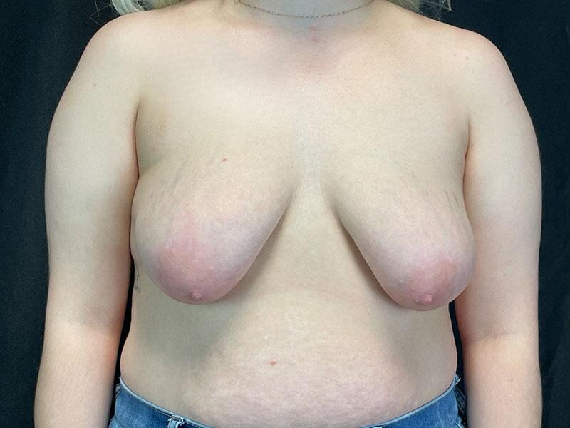 Breast Lift Before & After Image
