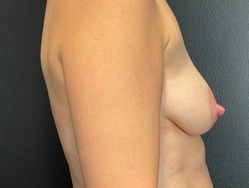 Breast Lift Before & After Image