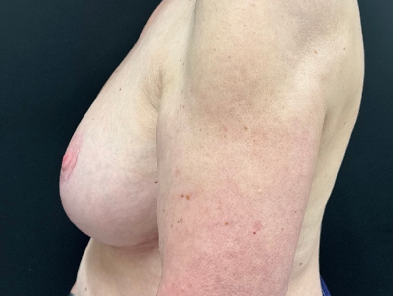 Breast Lift Before & After Image