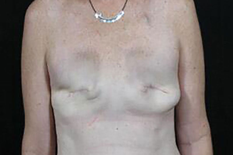 Breast Reconstruction Before & After Image