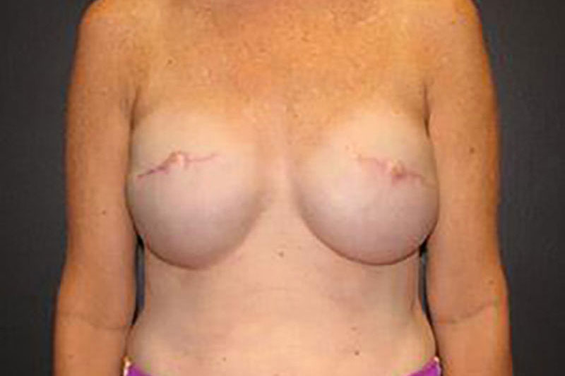 Breast Reconstruction Before & After Image