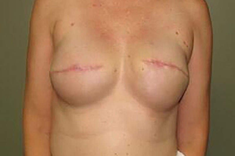 Breast Reconstruction Before & After Image