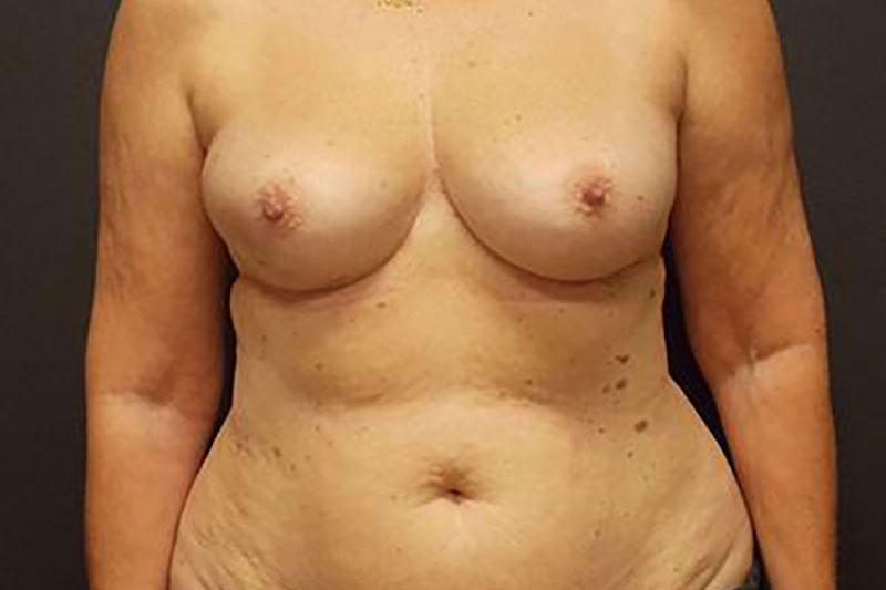 Breast Reconstruction Before & After Image