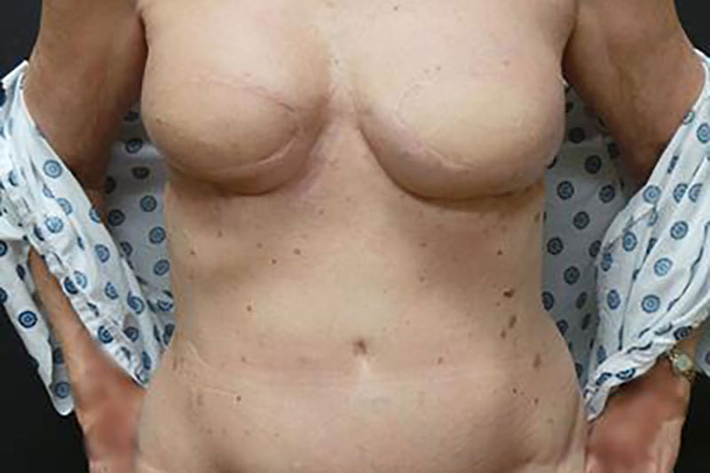 Breast Reconstruction Before & After Image