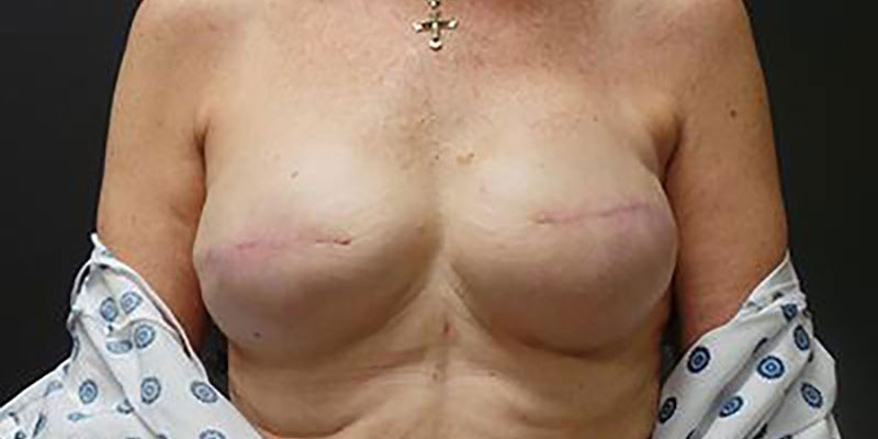 Breast Reconstruction Before & After Image