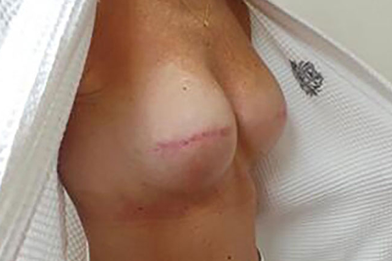 Breast Reconstruction Before & After Image