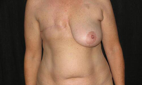 Breast Reconstruction Before & After Image