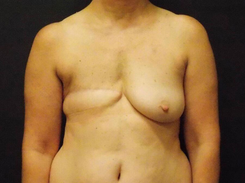 Breast Reconstruction Before & After Image