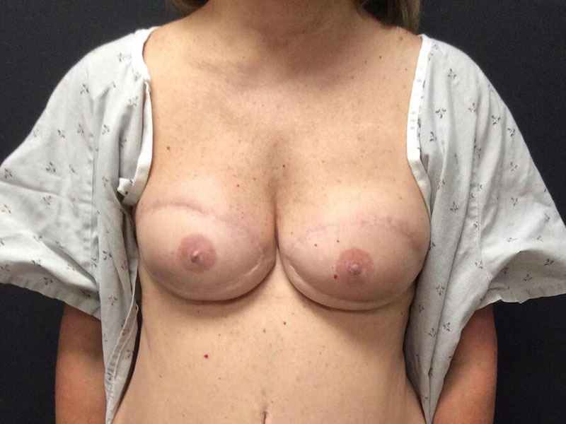 Breast Reconstruction Before & After Image