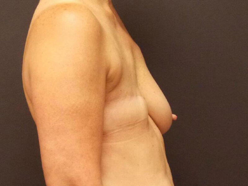 Breast Reconstruction Before & After Image