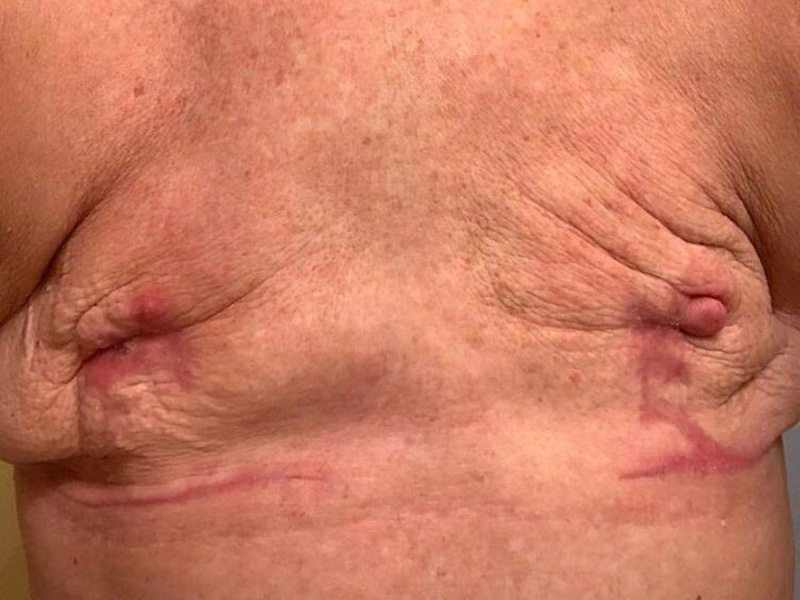 Breast Reconstruction Before & After Image