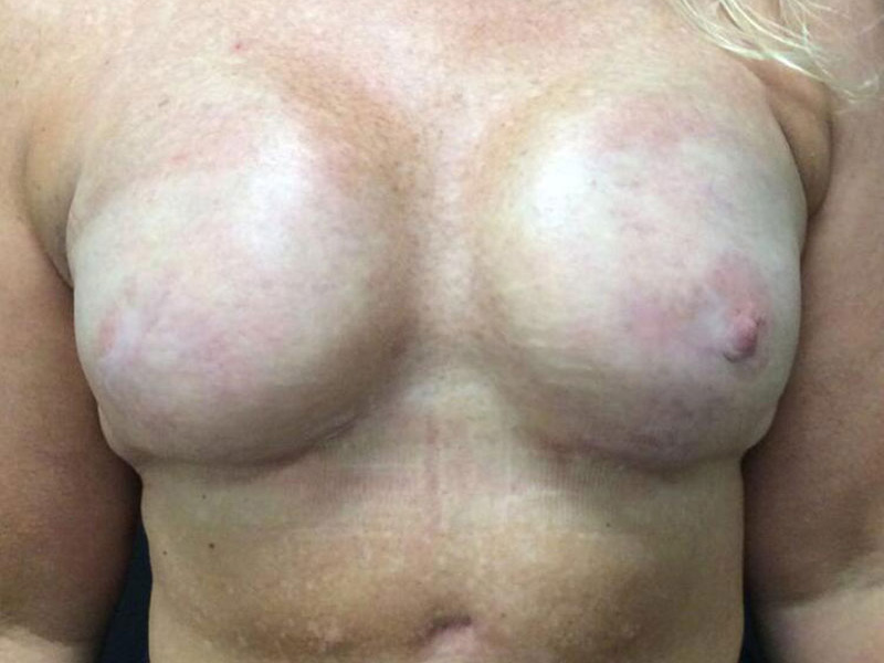 Breast Reconstruction Before & After Image