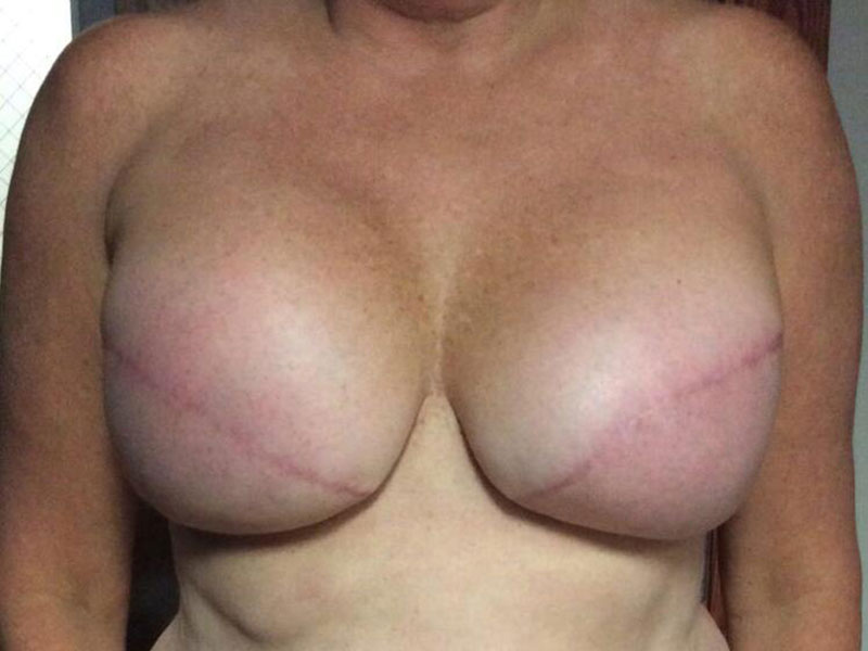 Breast Reconstruction Before & After Image