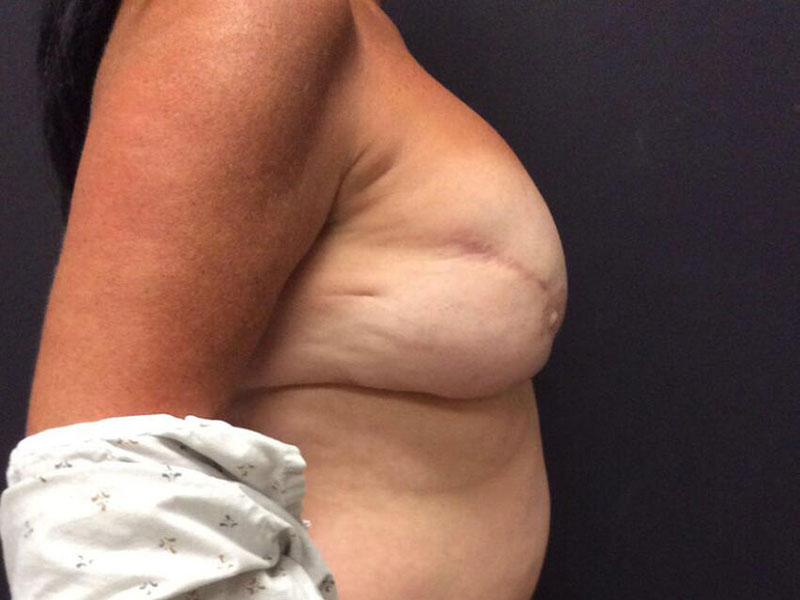 Breast Reconstruction Before & After Image