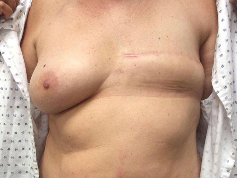 Breast Reconstruction Before & After Image