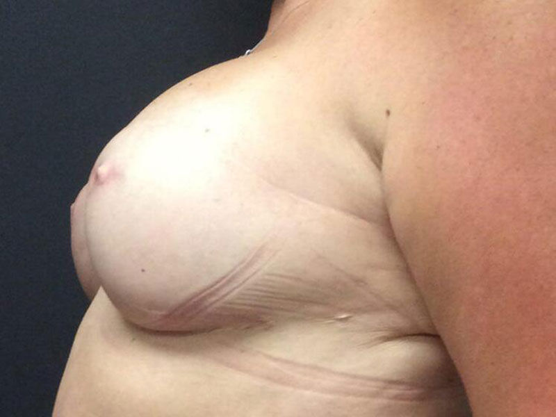 Breast Reconstruction Before & After Image