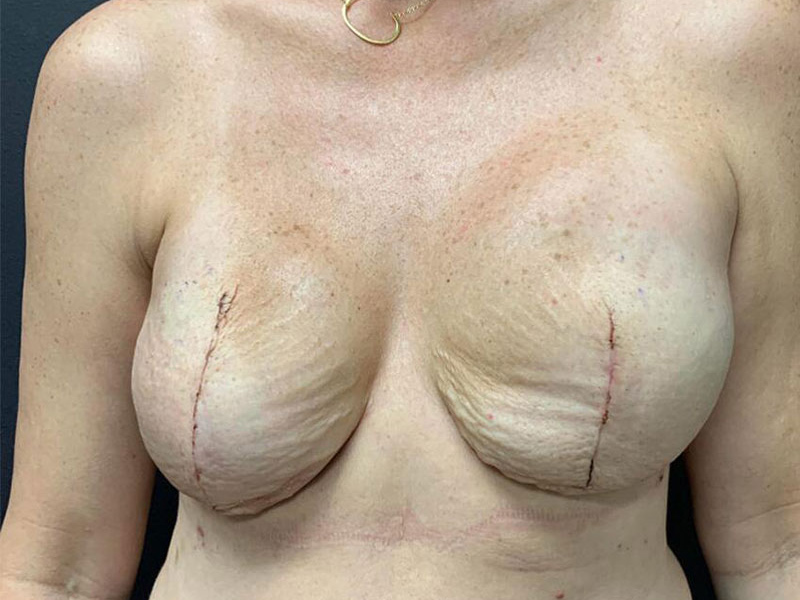 Breast Reconstruction Before & After Image