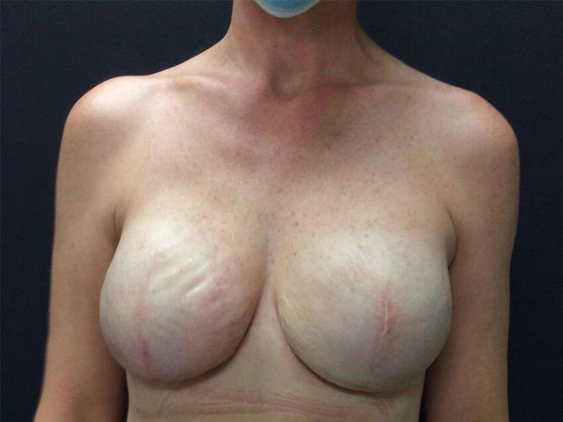 Breast Reconstruction Before & After Image