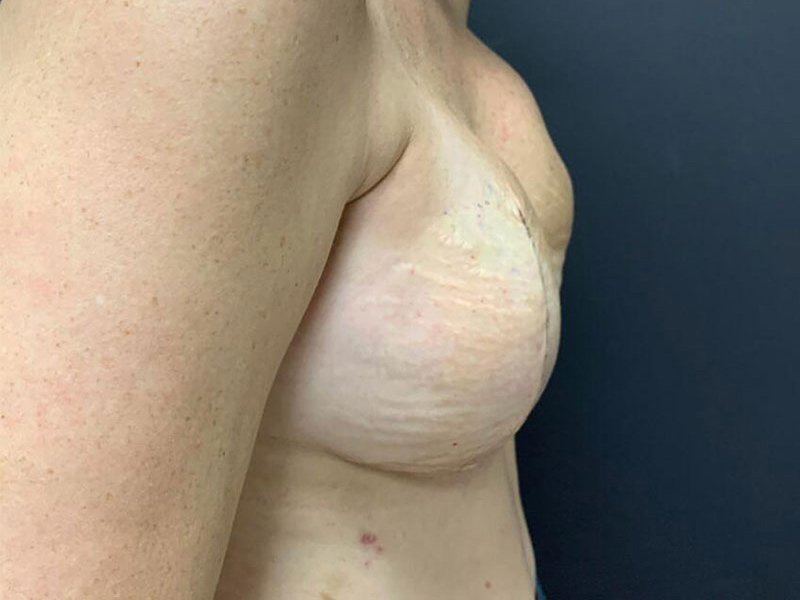 Breast Reconstruction Before & After Image