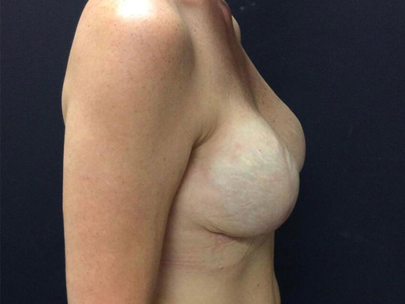 Breast Reconstruction Before & After Image