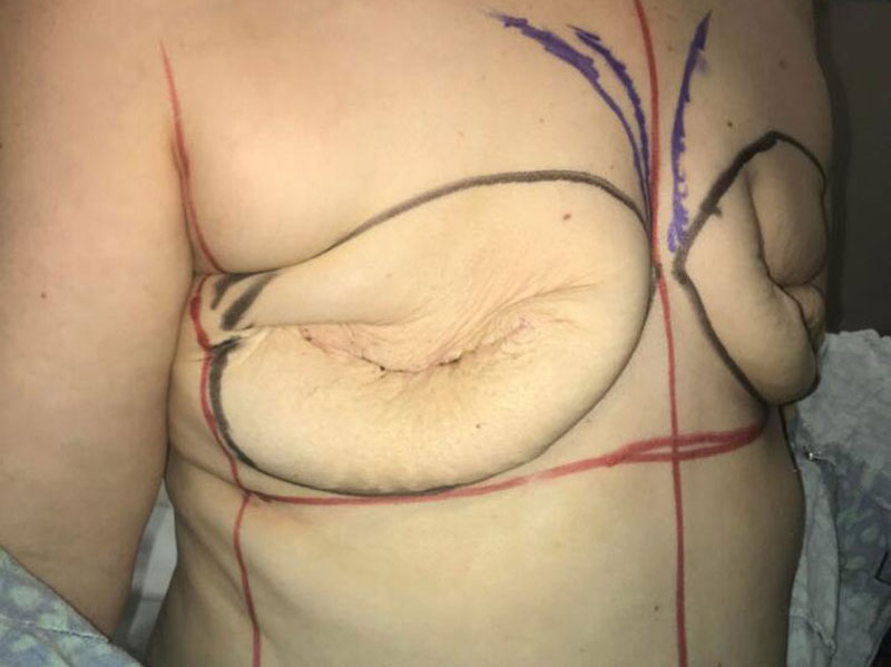 Breast Reconstruction Before & After Image