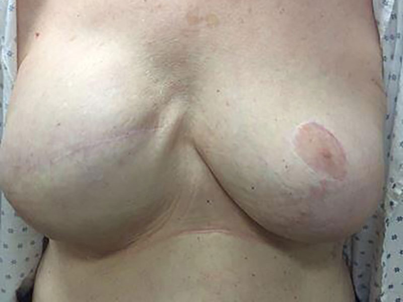 Breast Reconstruction Before & After Image