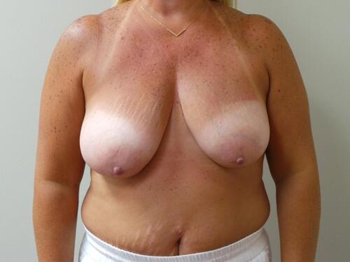 Breast Reduction Before & After Image