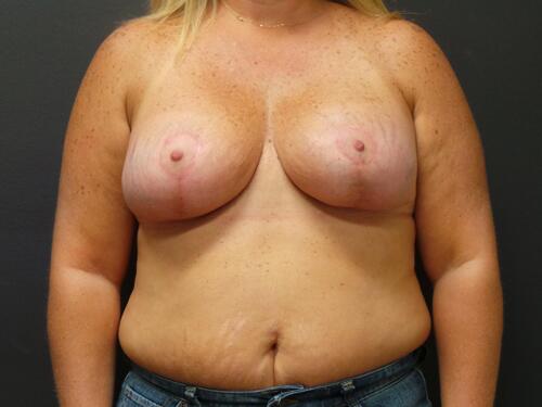 Breast Reduction Before & After Image