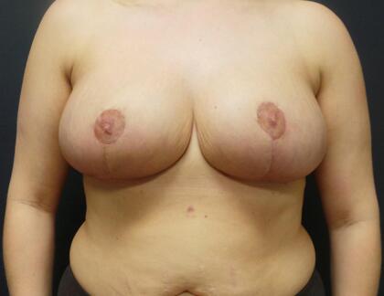 Breast Reduction Before & After Image