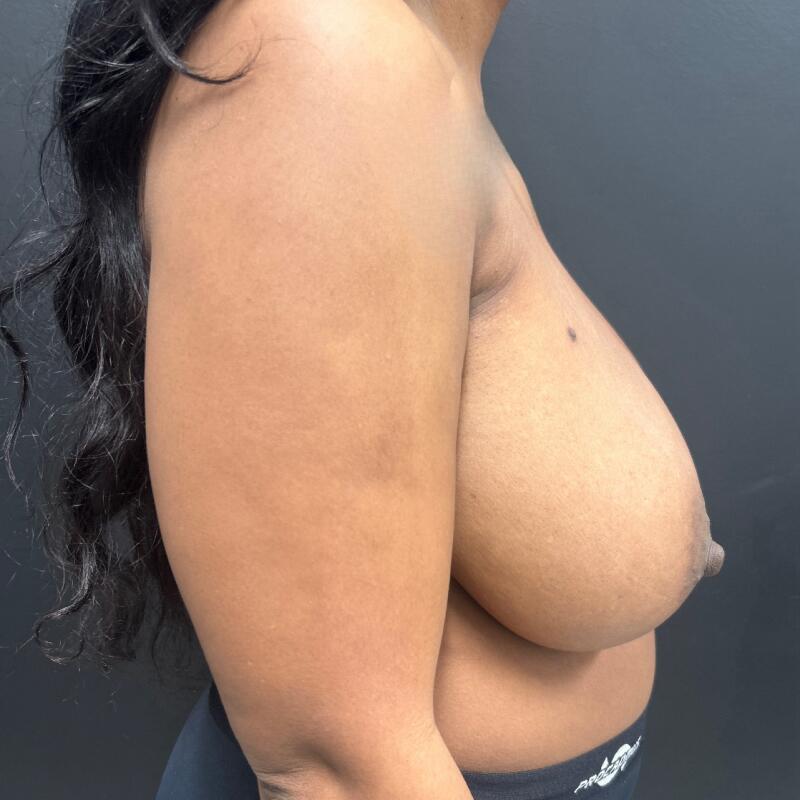 Breast Reduction Before & After Image