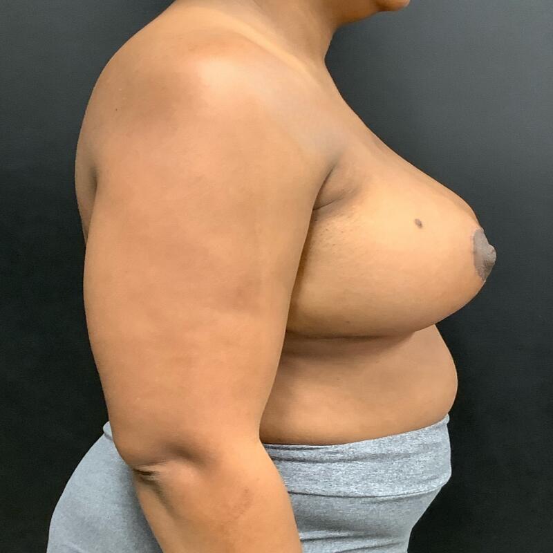 Breast Reduction Before & After Image