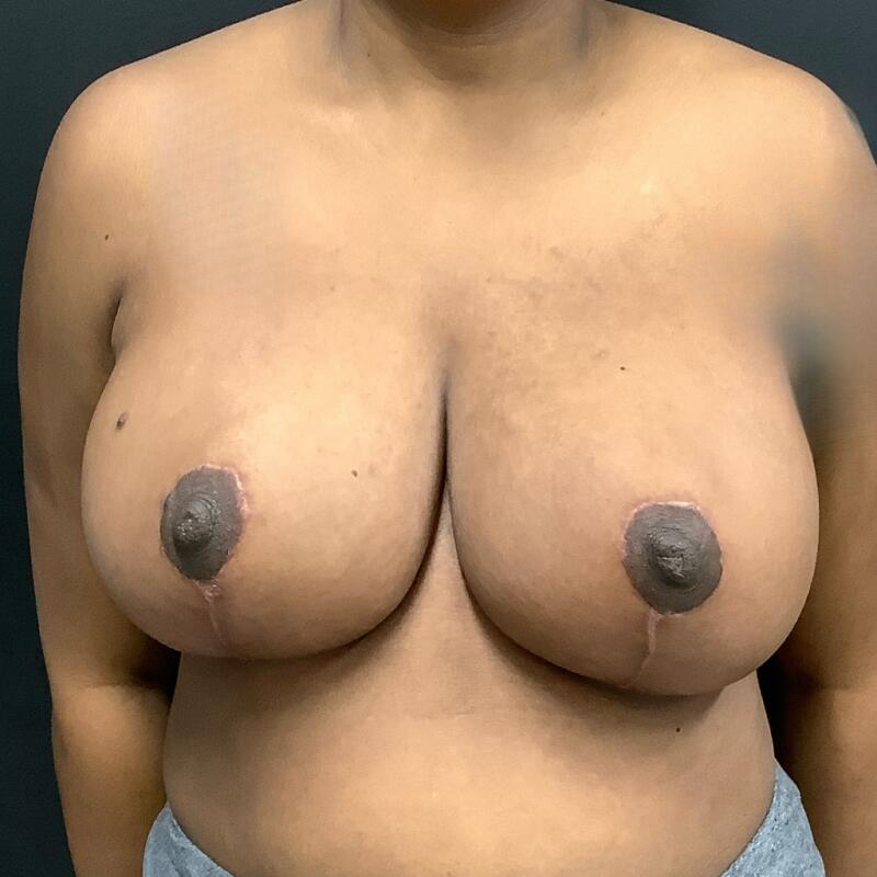 Breast Reduction Before & After Image