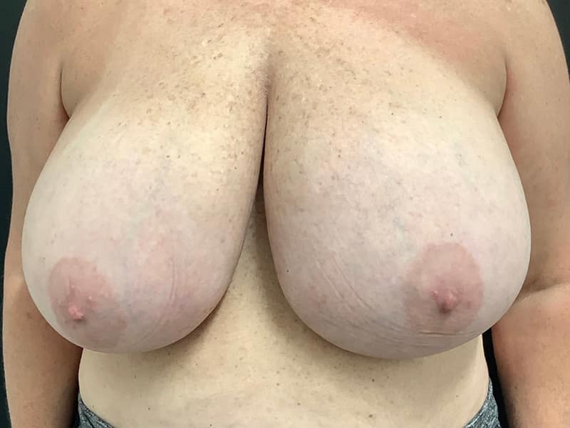 Breast Reduction Before & After Image