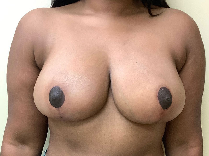 Breast Reduction Before & After Image