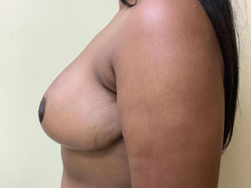 Breast Reduction Before & After Image